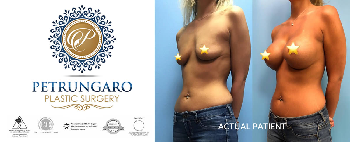 Breast augmentation with implants