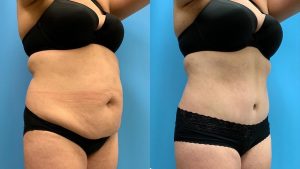 33-female-before-after-tummy-tuck-lipo-360-feature