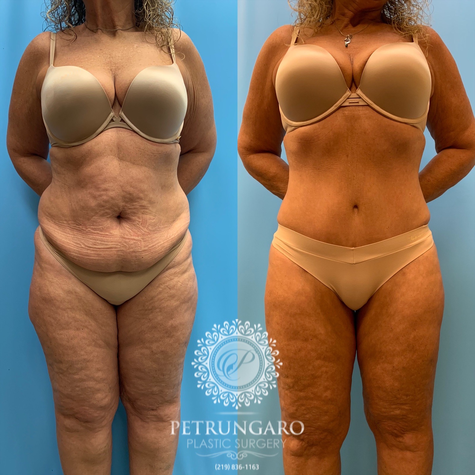 56 year old tummy tuck, Lipo 360-1