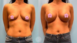 breast-augmentation-featured