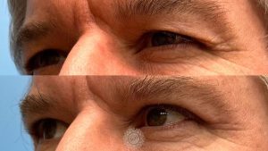 upper blepharoplasty eyelid lift featured