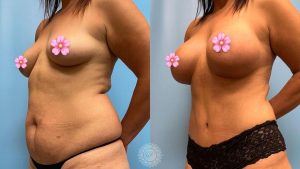 periareolar-donut-breast-lift-with-implants-tummy-tuck-with-Lipo-360-featured
