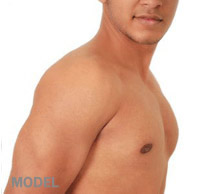 male-breast-surgery-results breast-reduction-male-results-2