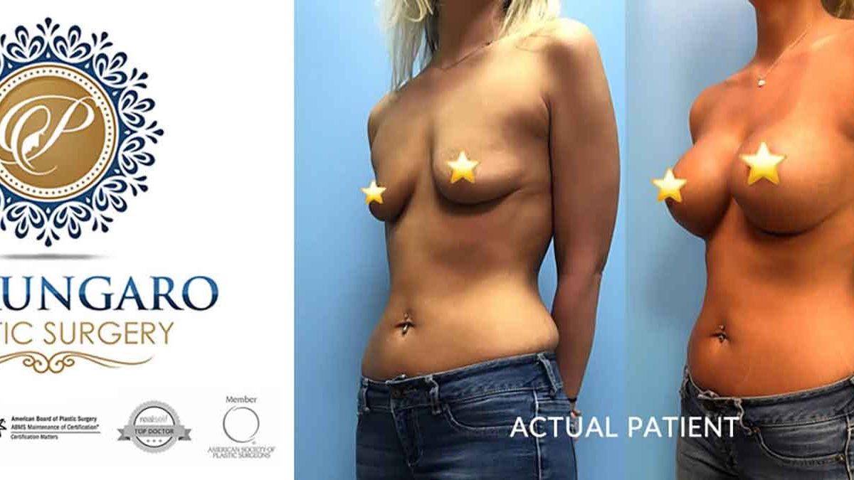 Gummy Bear Breast Implants Beverly Hills - Gummy Bear Breast Procedure  Beverly Hills