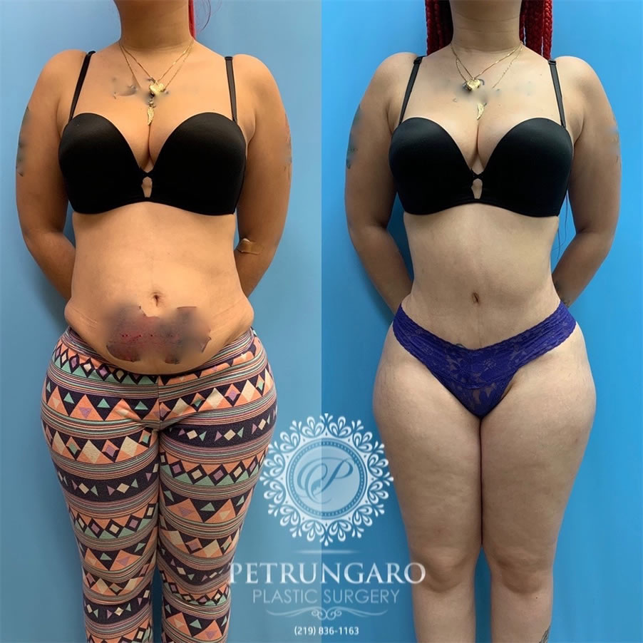 https://www.petrungaroplasticsurgery.com/wp-content/uploads/2019/08/27-woman-before-after-photo-tummy-tuck-lipo-360-1@2x.jpg