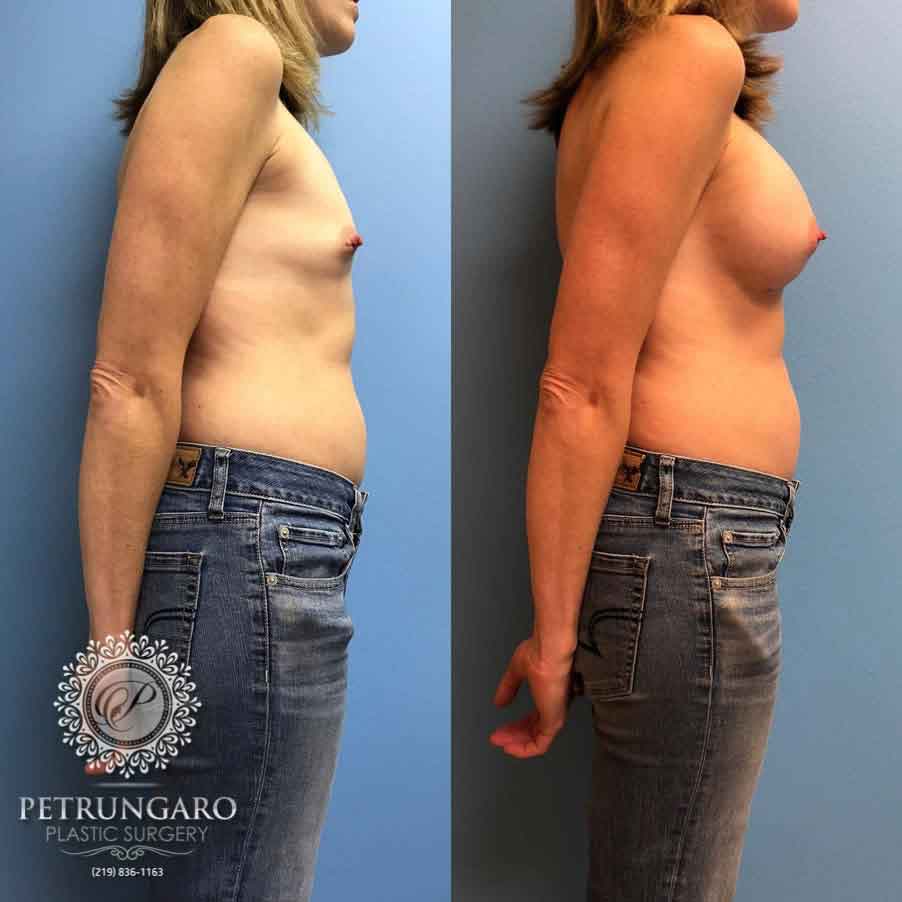 40 F After Breast Augmentation
