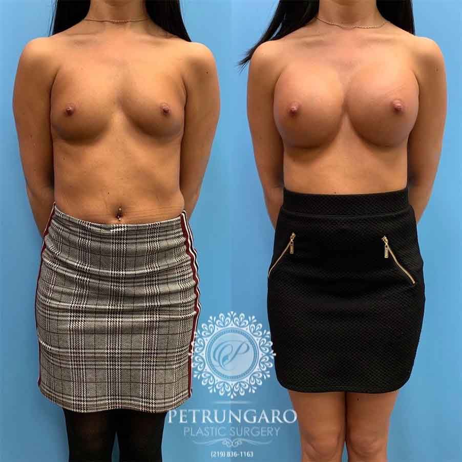 26-before-after-photo-breast-augmentation-1