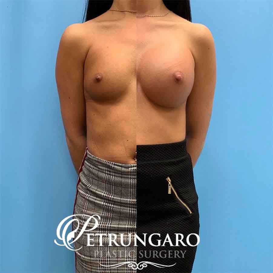 26-before-after-photo-breast-augmentation-6