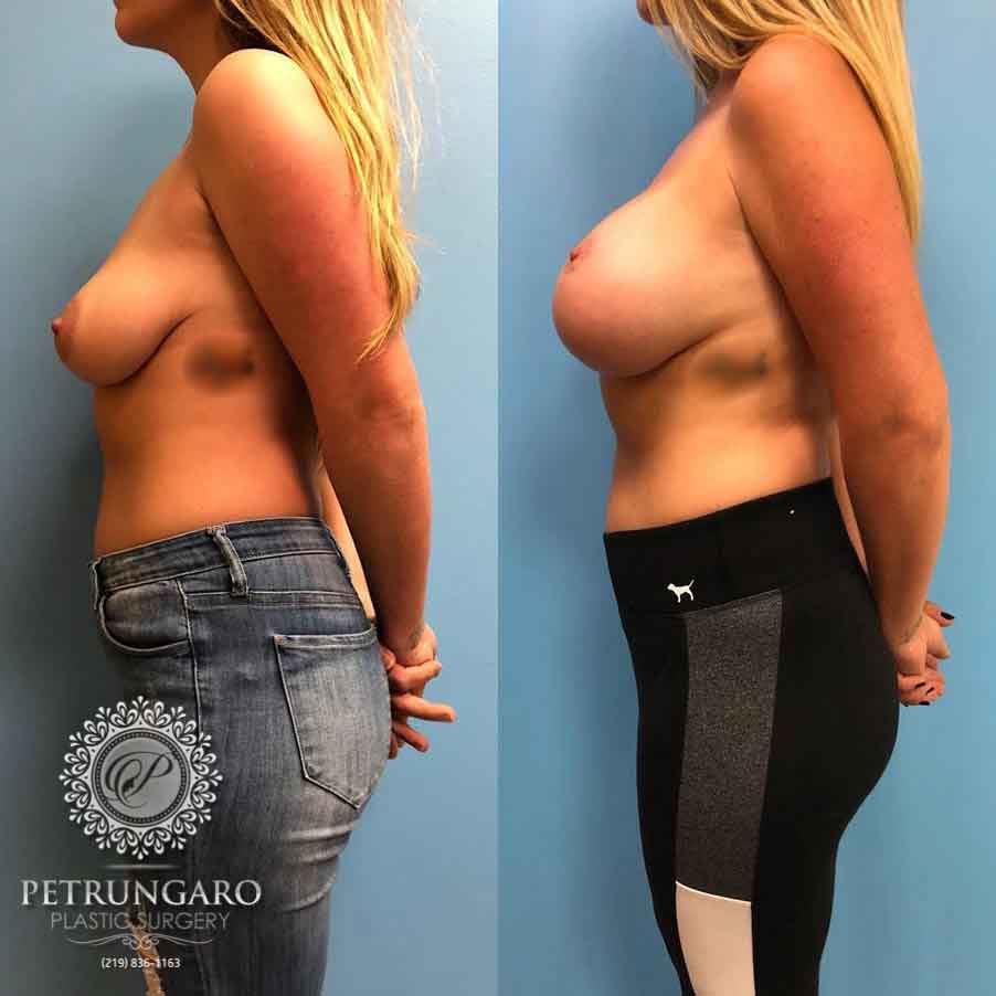 26-breast-lift-with-implants-2