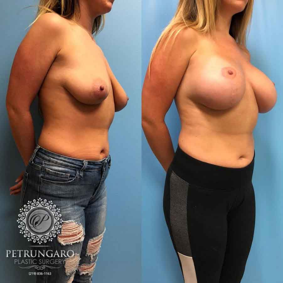 26-breast-lift-with-implants-5