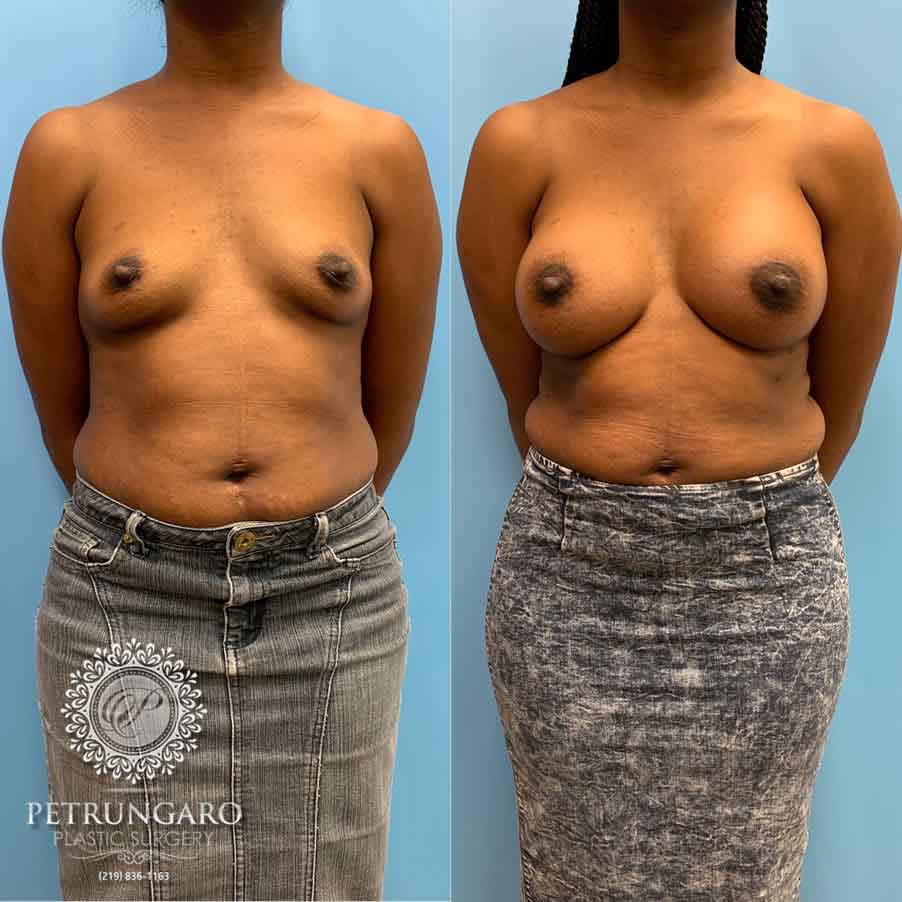28-before-after-breast-augmerntation-1