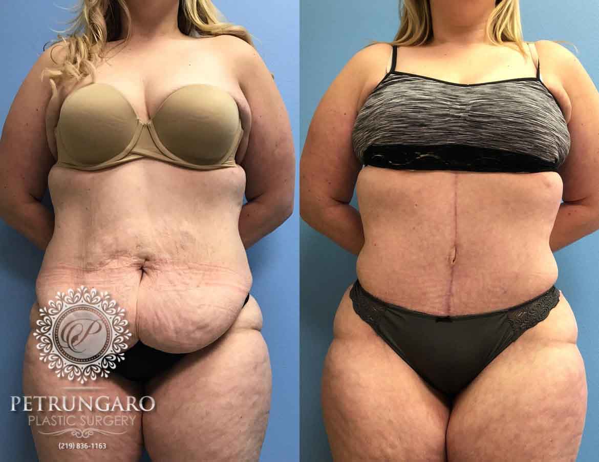 Fleur de Lis Tummy Tuck after massive weight loss by Dr Hunt in Sydney