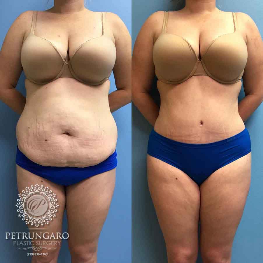 46 F After Tummy Tuck with Lipo 360