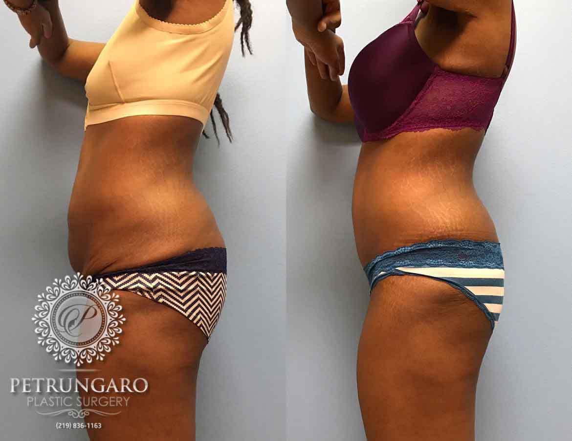 31-year-old-woman-3-months-after-Tummy-Tuck-3