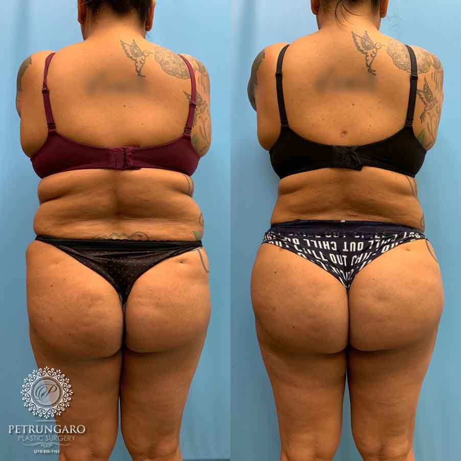 2 weeks post op #liposuction #bbl #brazilianbutlift #recovery #lipo360