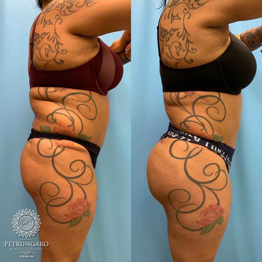 🔥Lipo 360🔥 This 34 year old was unhappy with the appearance of