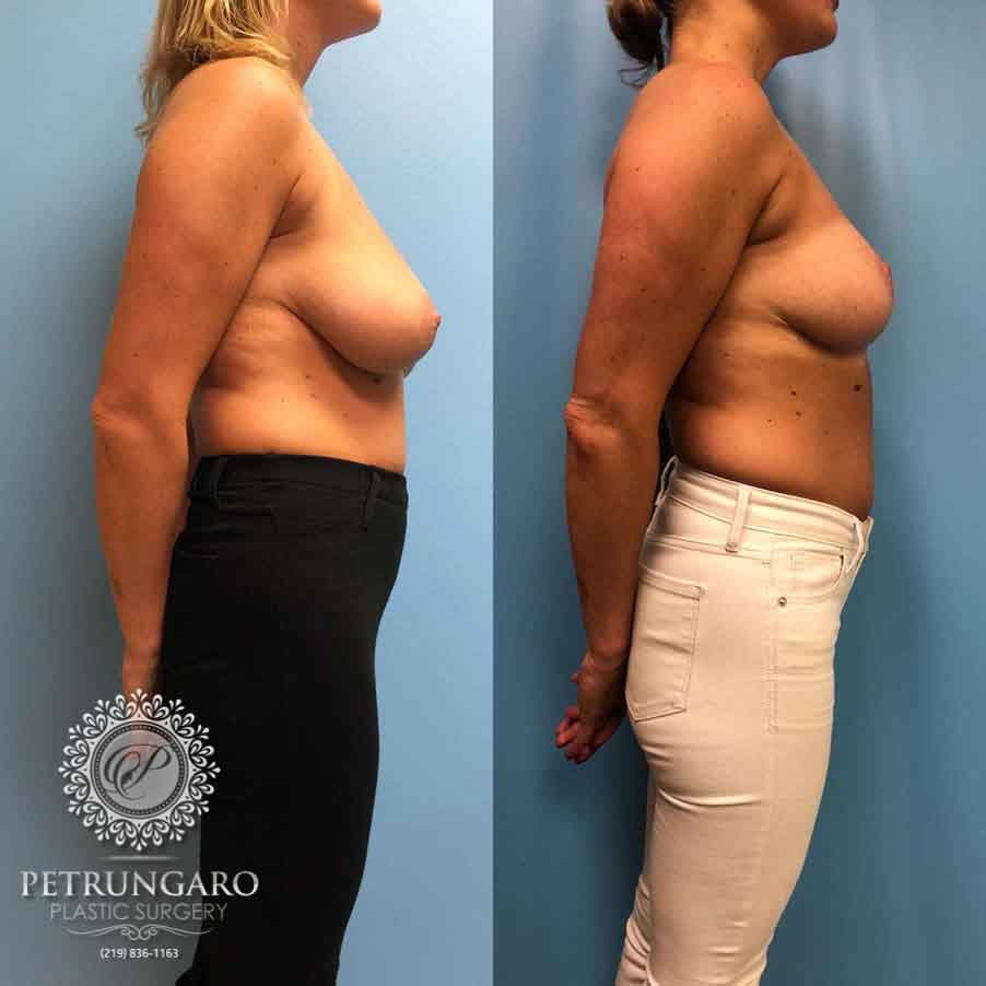 36-before-after-breast-lift-3