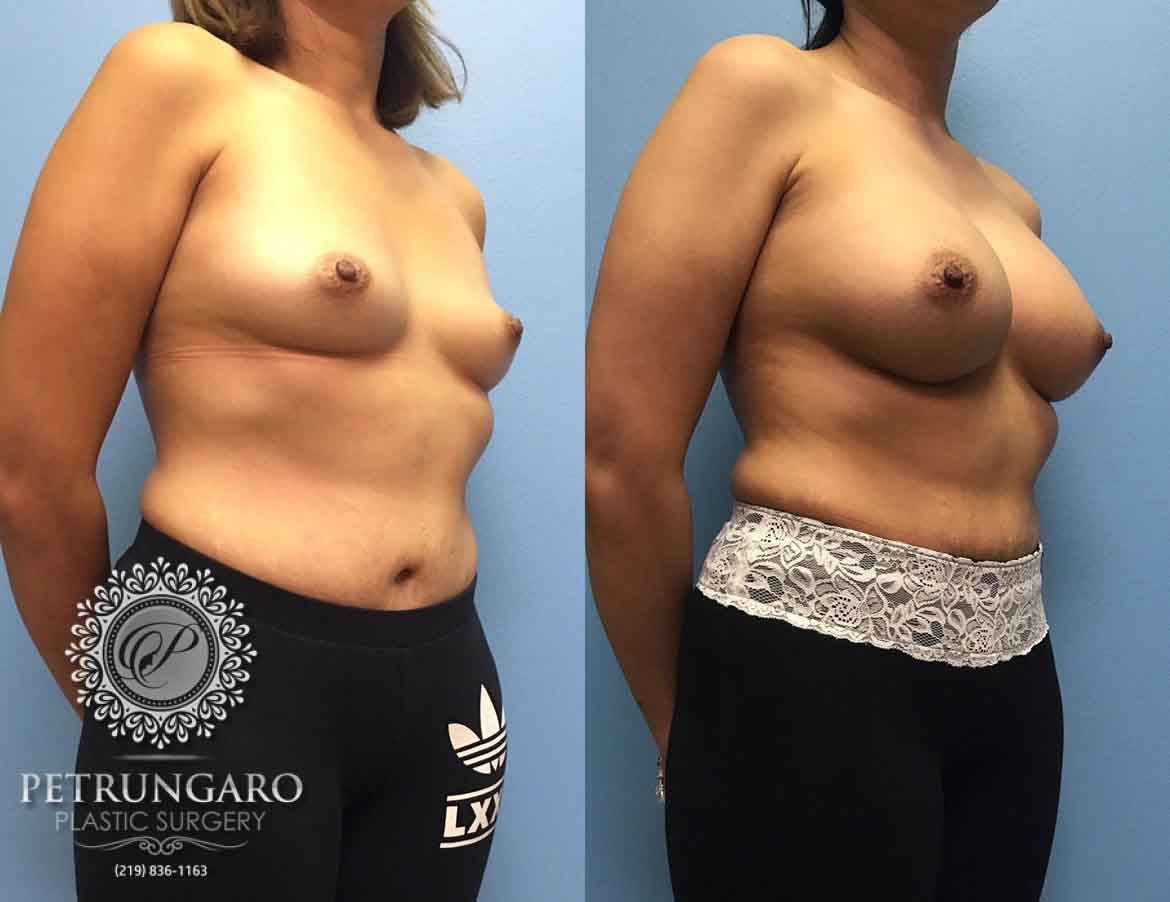 https://www.petrungaroplasticsurgery.com/wp-content/uploads/2019/09/36-woman-3-months-after-breast-augmentation-1b.jpg