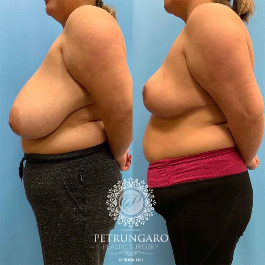 40 Year Woman After Breast Reduction