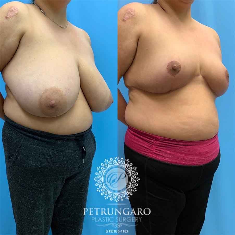 Breast Reduction  Petrungaro Plastic Surgery