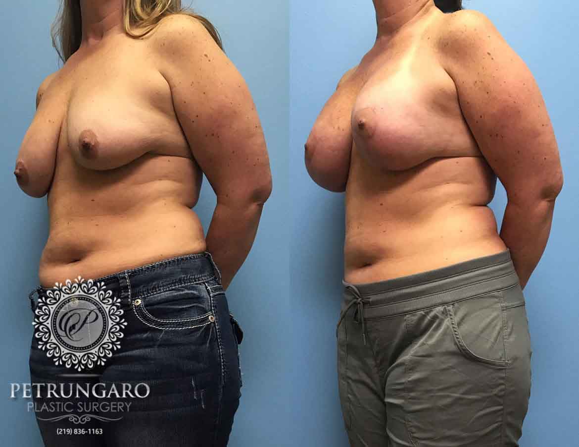 42 F After Breast Lift Augmentation