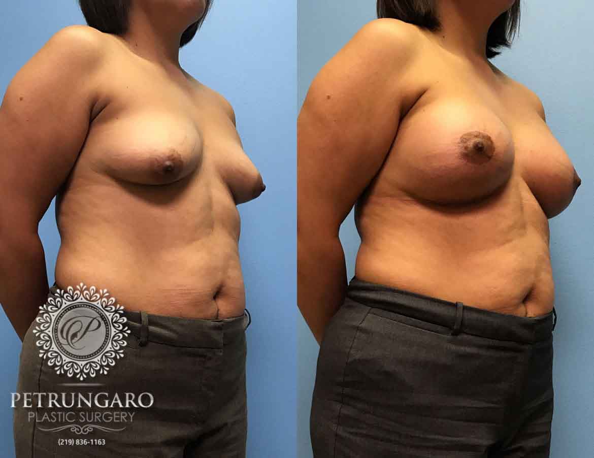 42-breast-lift-aumentation-1