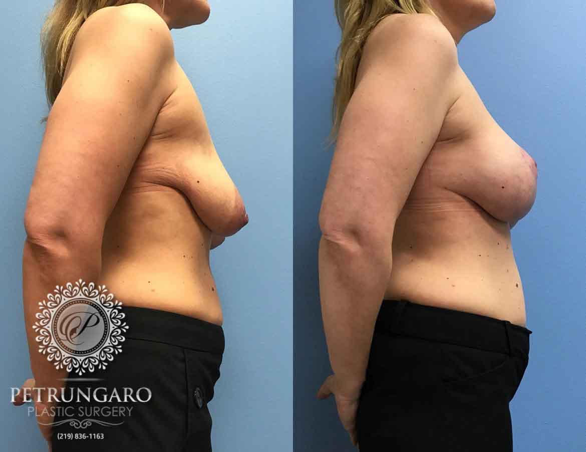 43-breast-lift-with-implants-2