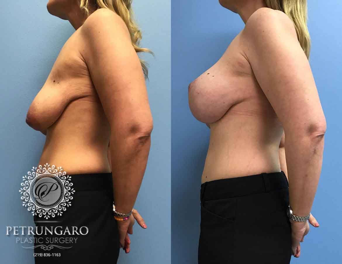 43 F After Breast Lift with Implants