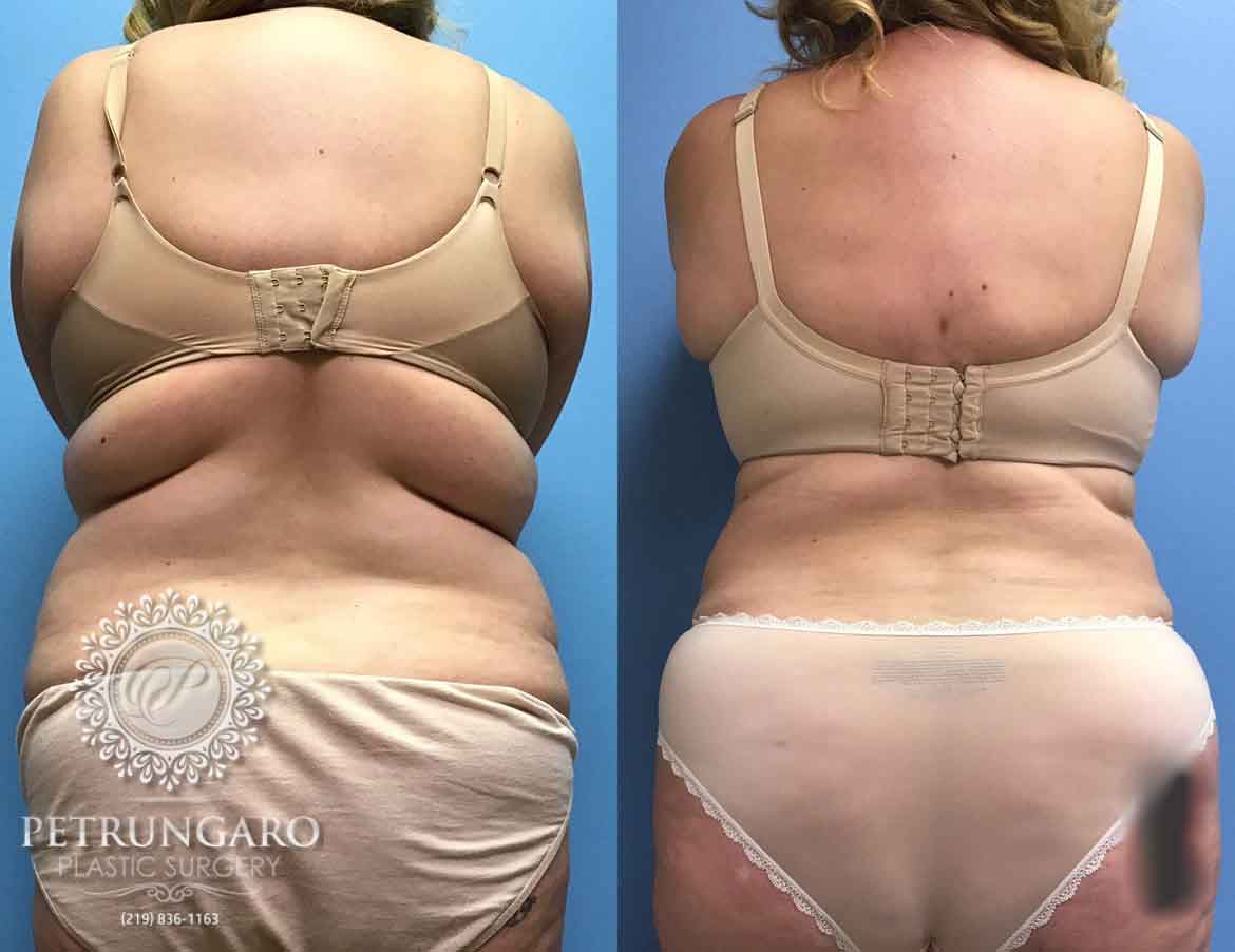 43 F After Tummy Tuck with Lipo 360