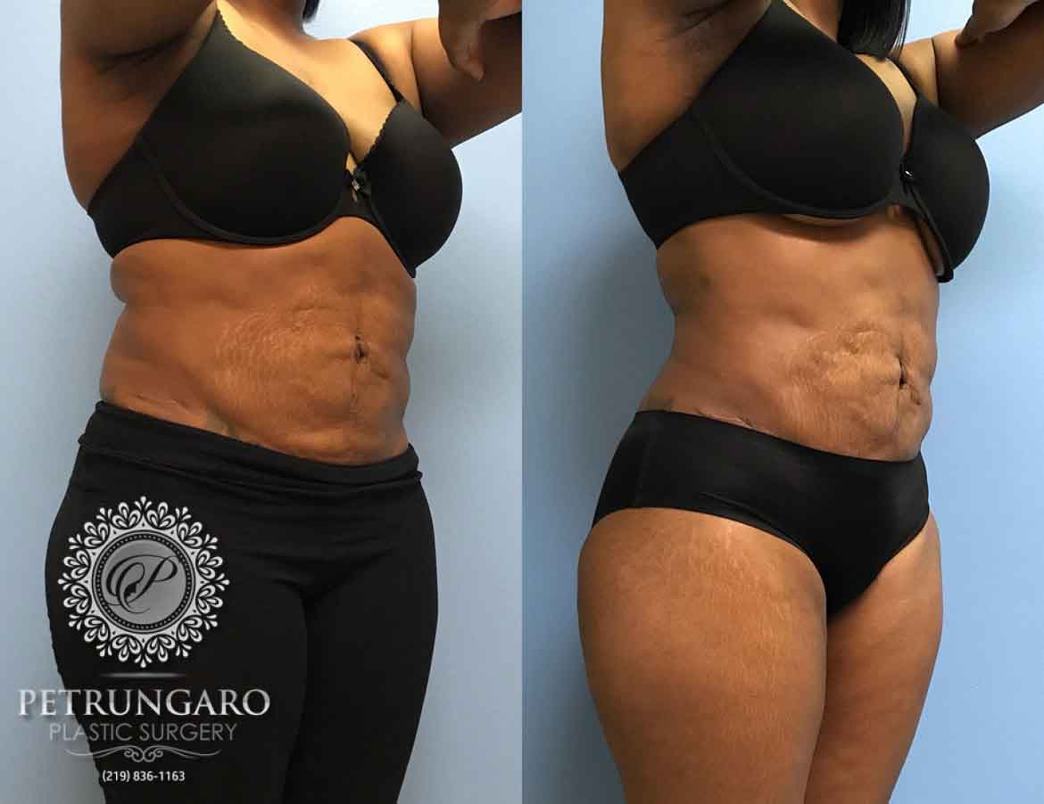 https://www.petrungaroplasticsurgery.com/wp-content/uploads/2019/09/43-year-old-woman-3-months-after-liposuction-3.jpg