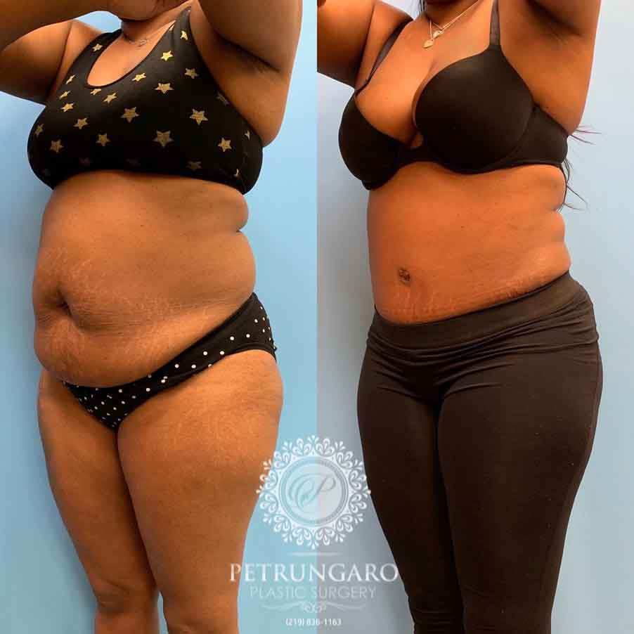 Tummy Tuck Before and After Photo Gallery, Page 3 of 4