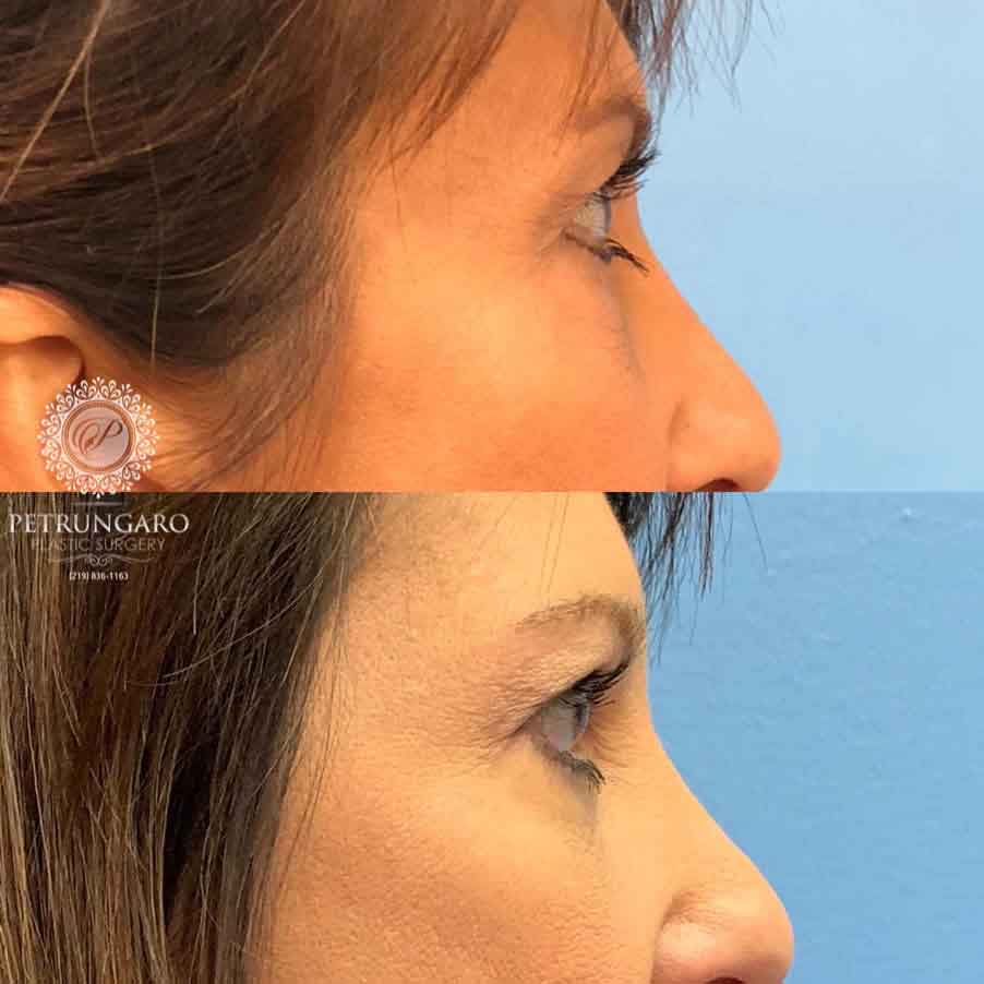 47-woman-before-after-eyelid-surgery-2