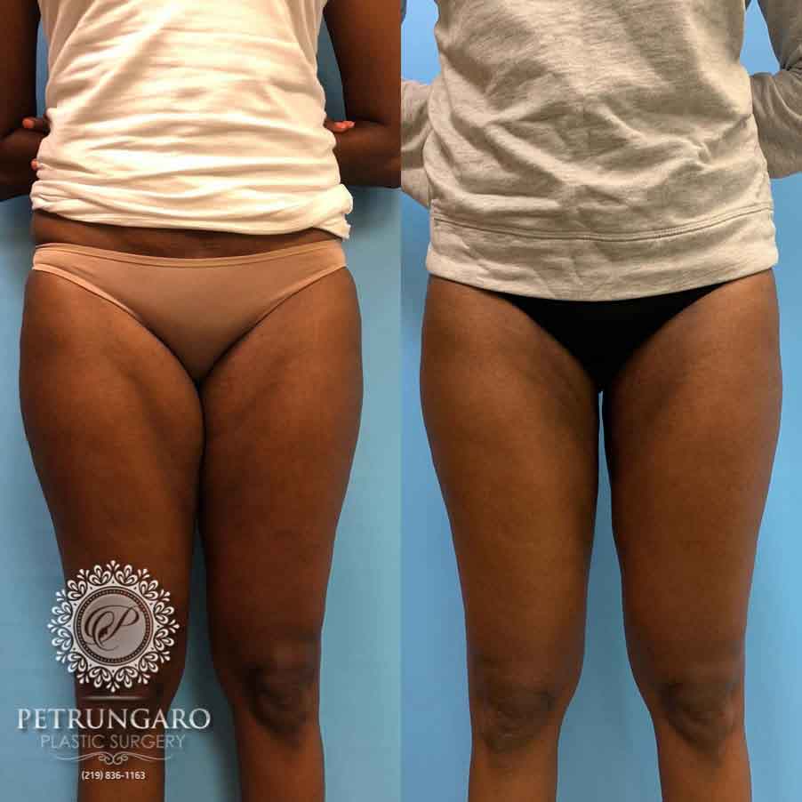 Hips/Thighs - KleinLipo - Liposuction Surgery of Orange County