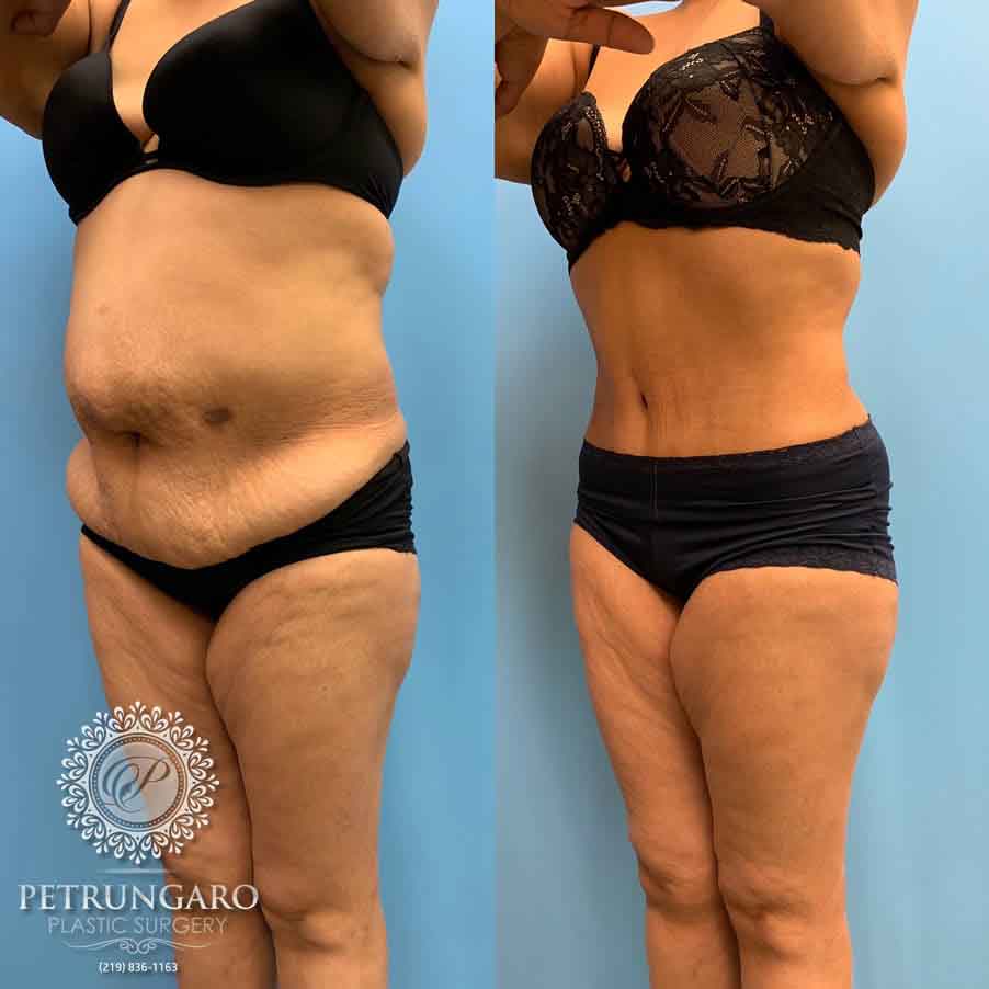 52 F After Tummy Tuck with Lipo 360