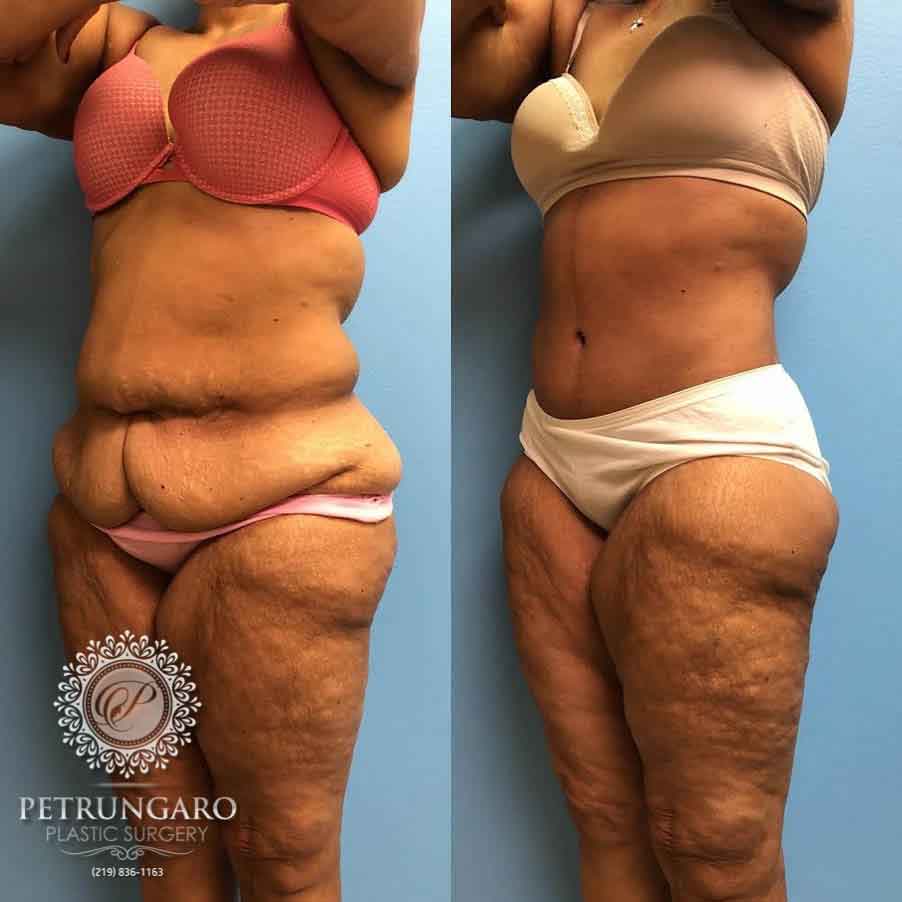 Before /after Fleur De Lis surgery & Leg lift Getsliminturkey