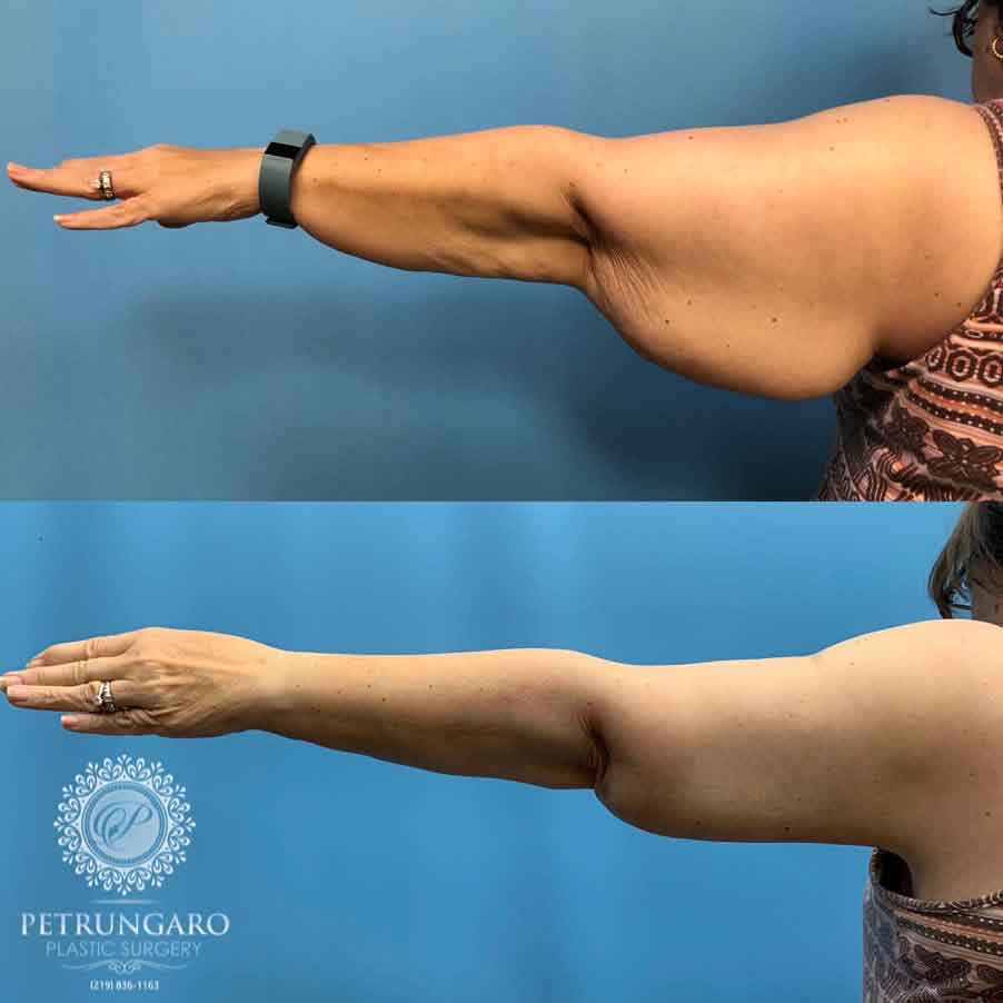 58-woman-before-after-armlift-4