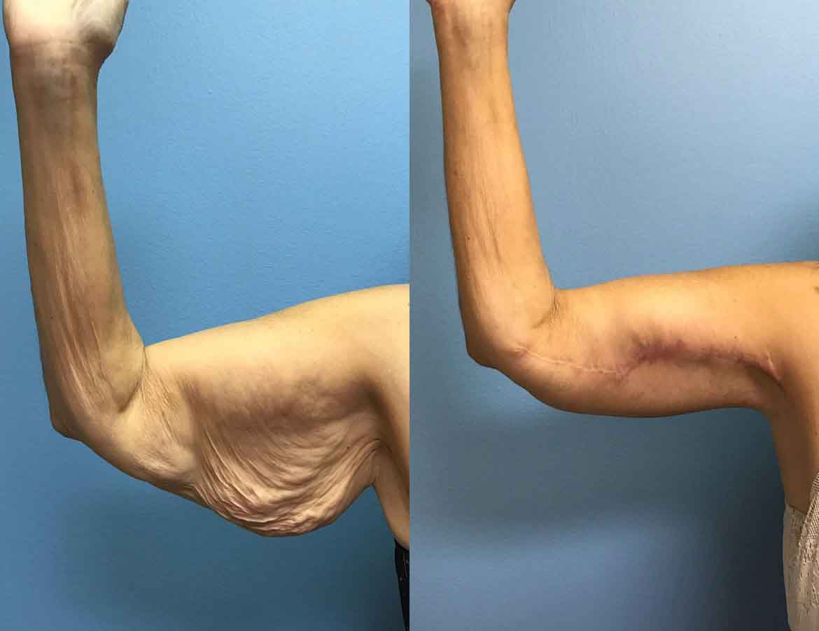 Liposuction Before & After Gallery: Patient 61
