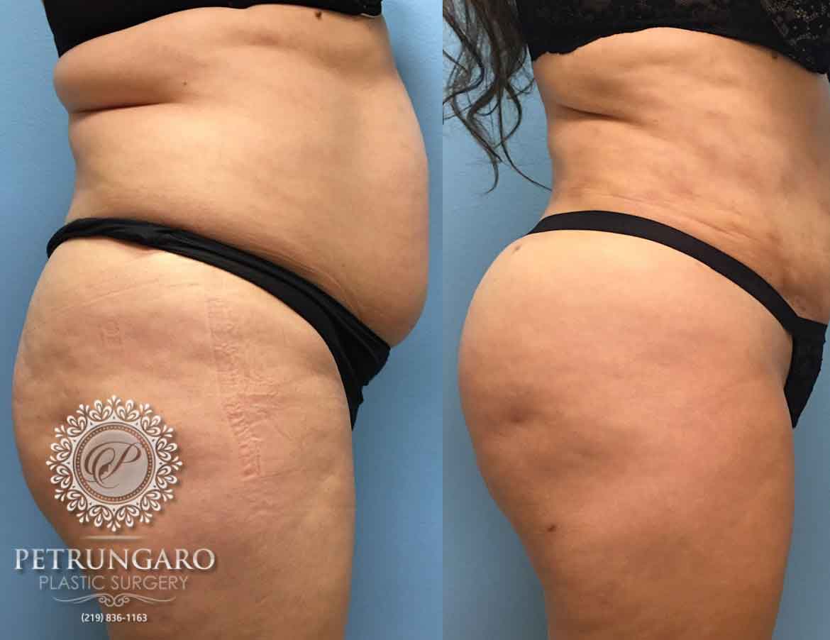 Brazilian Butt Lift Before & After Gallery: Patient 24