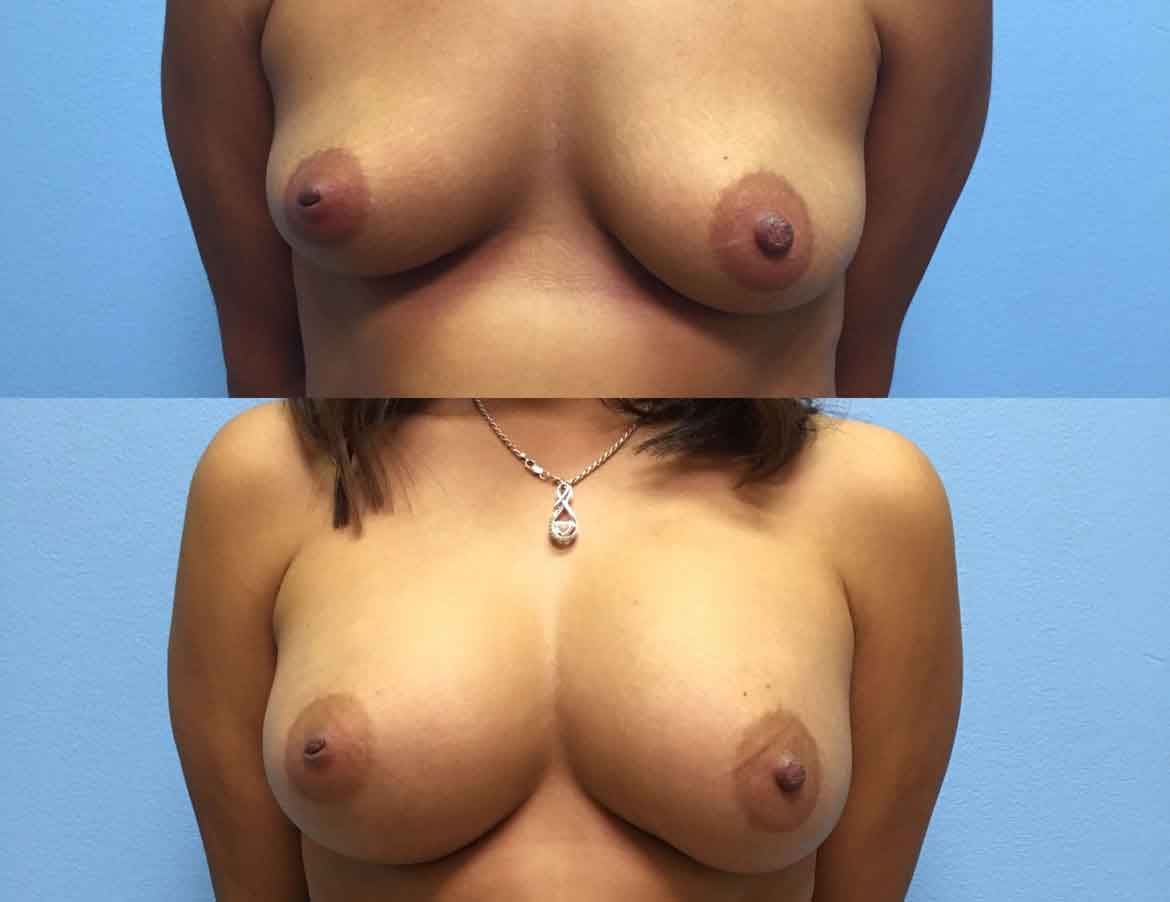 before-after-breast-implants-augmentation-1c