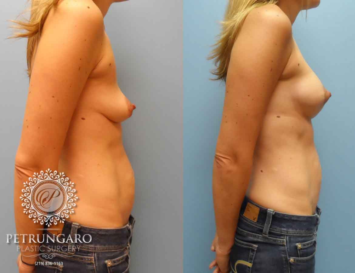 before-after-breast-implants-augmentation-lift-4b