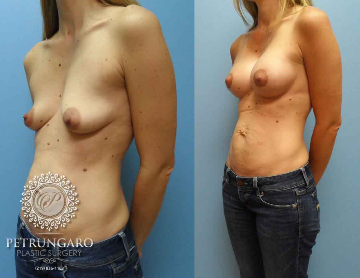 before-after-breast-implants-augmentation-lift-4c
