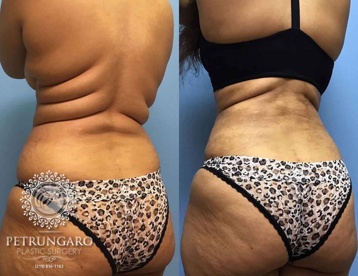 before-after-liposuction-1e