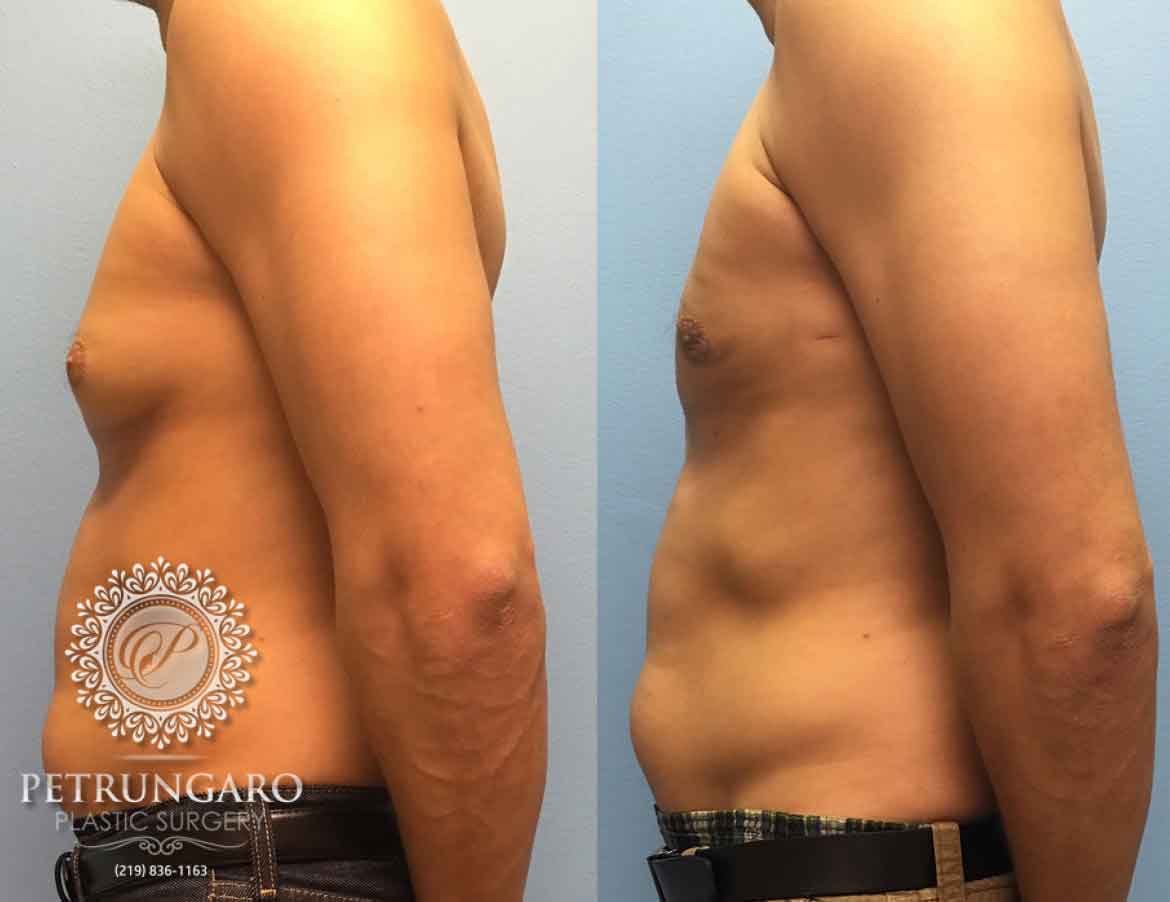 before-after-male-gynecomastia-1b