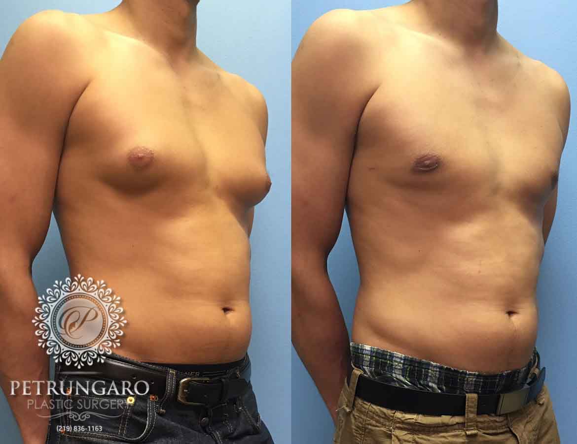 before-after-male-gynecomastia-1c