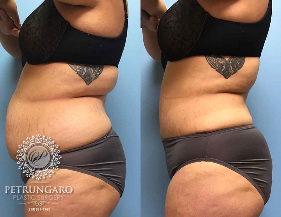 before-after-tummy-tuck-3d