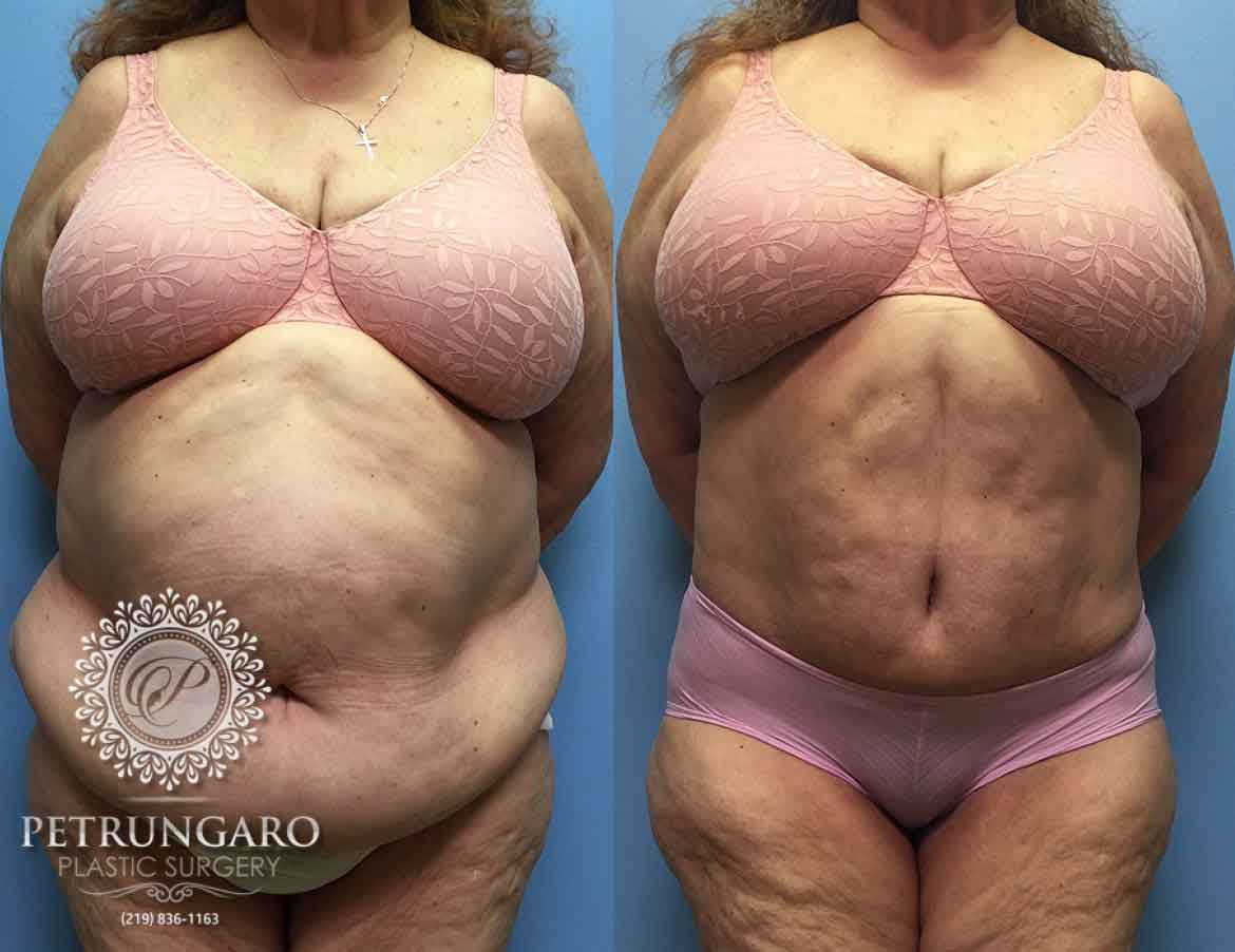 before-after-tummy-tuck-with-liposuction-5a