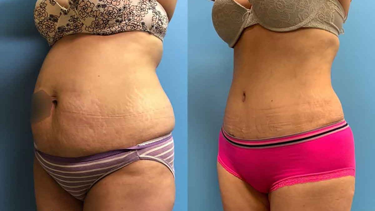 Plus size: Extended Tummy tuck with lipo on flanks - Review - RealSelf