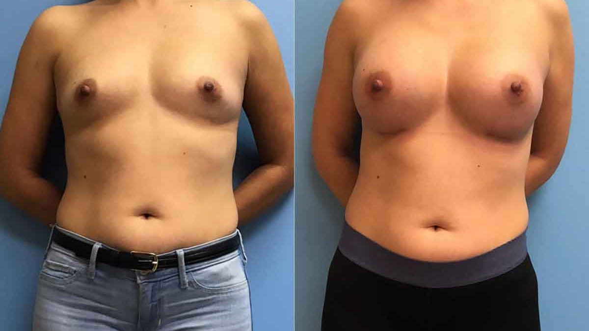https://www.petrungaroplasticsurgery.com/wp-content/uploads/2019/09/cropped-36-breast-augmentation-implants-feature.jpg