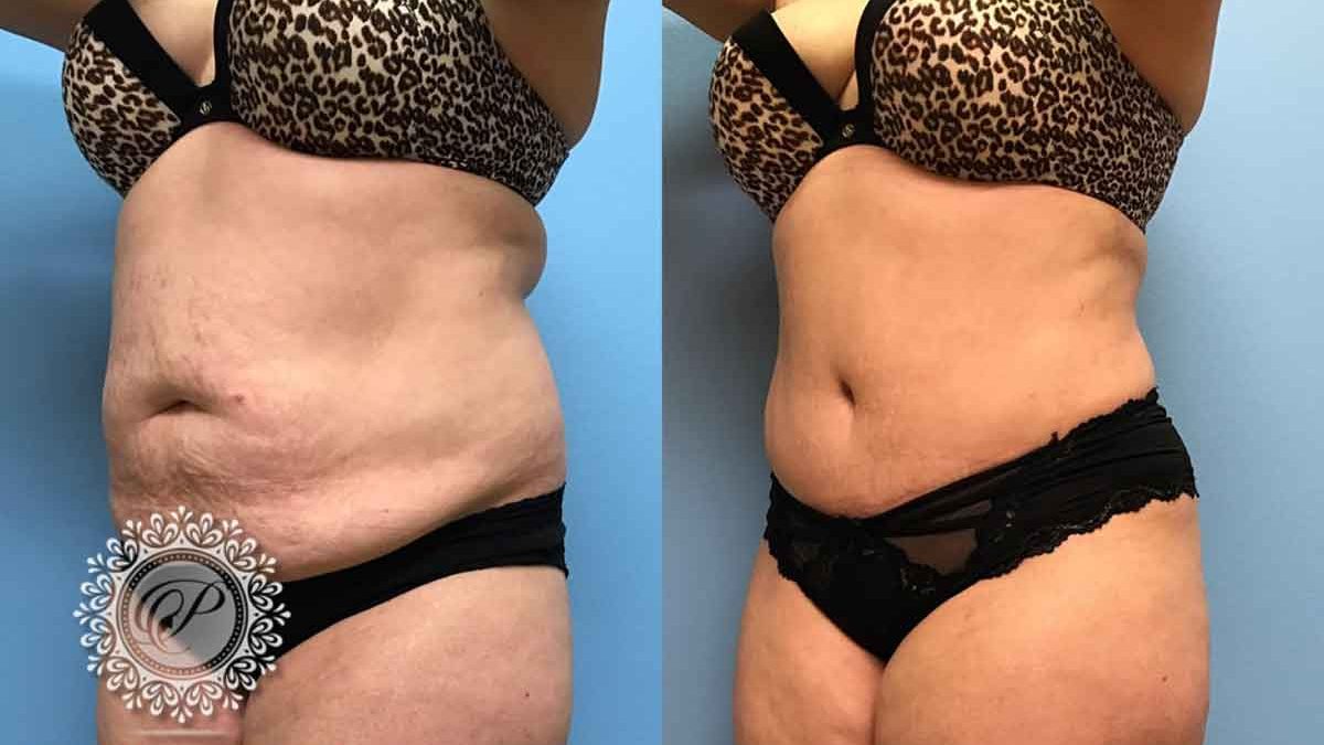 52 F After Tummy Tuck with Lipo 360