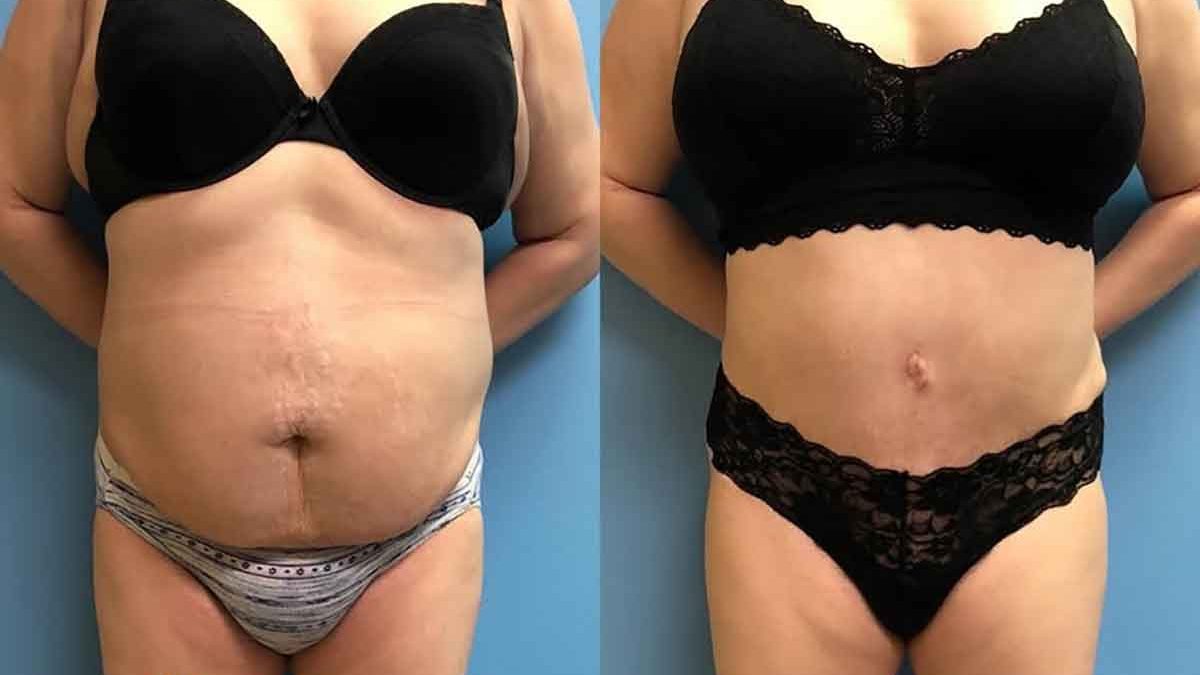 42 F After Tummy Tuck with Lipo 360